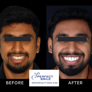 clier aligner treatment Kolkata