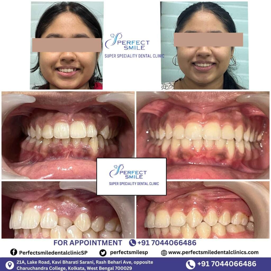 Braces Treatment Testimonials in Kolkata, Braces before and after in Kolkata, Orthodontist testimonials Kolkata, Braces results in Kolkata
