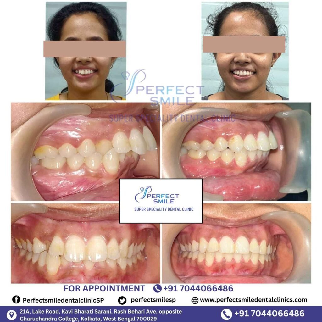Braces Treatment Testimonials in Kolkata, Braces before and after in Kolkata, Orthodontist testimonials Kolkata, Braces results in Kolkata