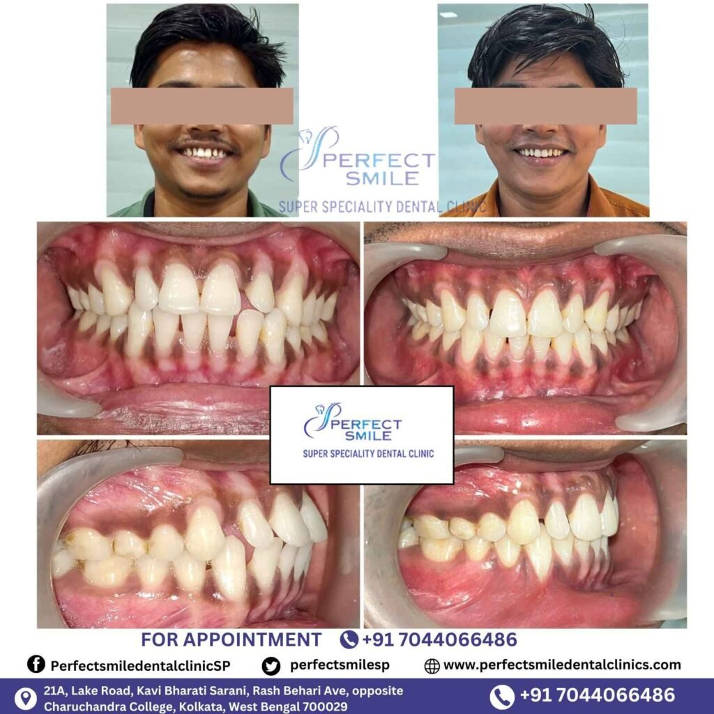 Braces Treatment Testimonials in Kolkata, Braces before and after in Kolkata, Orthodontist testimonials Kolkata, Braces results in Kolkata