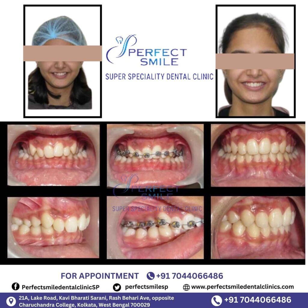 Braces Treatment Testimonials in Kolkata, Braces before and after in Kolkata, Orthodontist testimonials Kolkata, Braces results in Kolkata