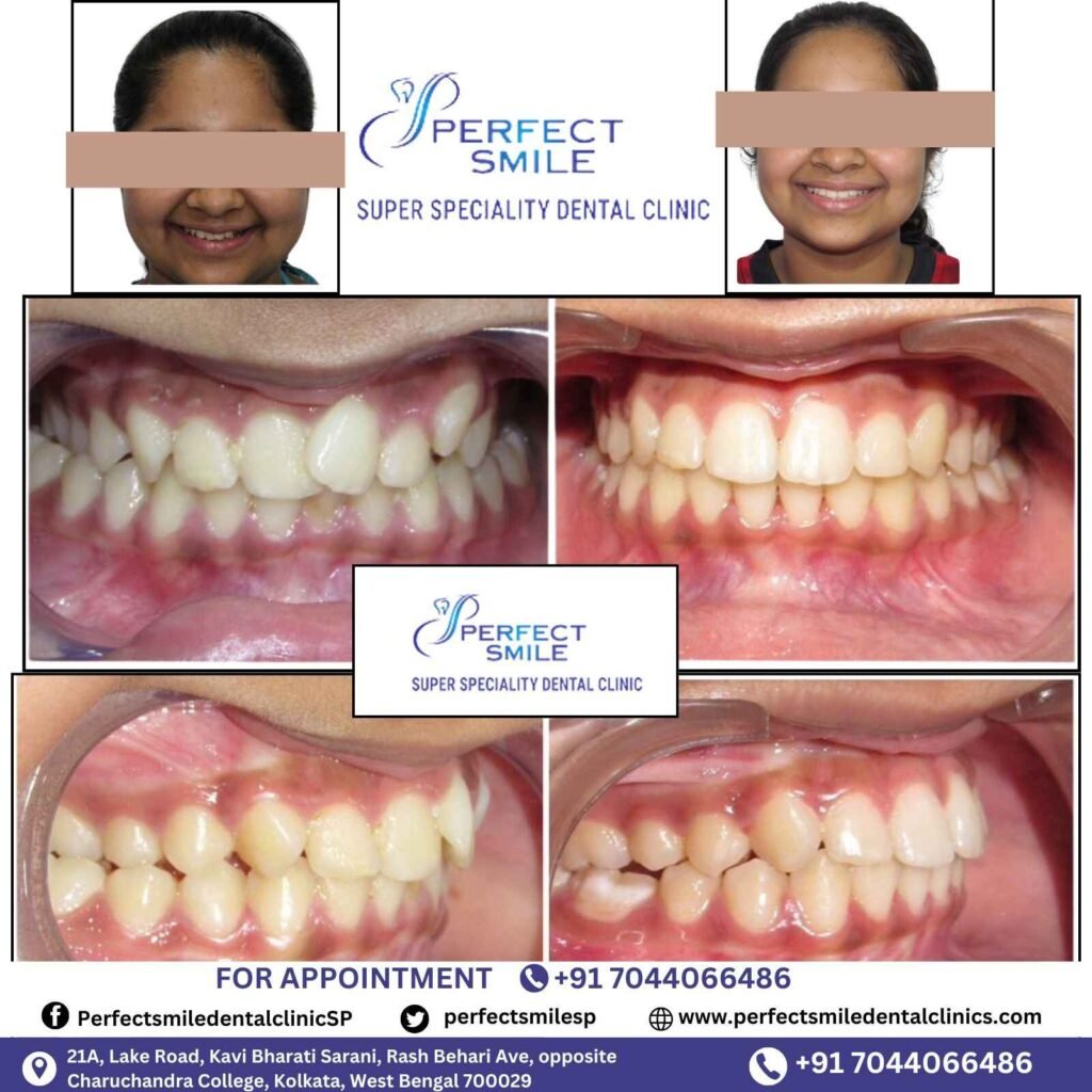 Braces Treatment Testimonials in Kolkata, Braces before and after in Kolkata, Orthodontist testimonials Kolkata, Braces results in Kolkata