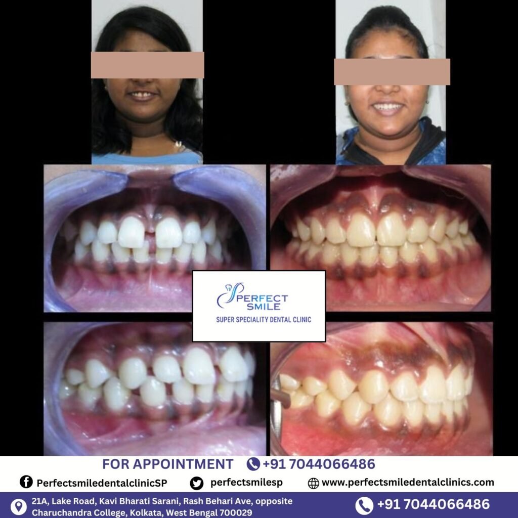 Braces Treatment Testimonials in Kolkata, Braces before and after in Kolkata, Orthodontist testimonials Kolkata, Braces results in Kolkata