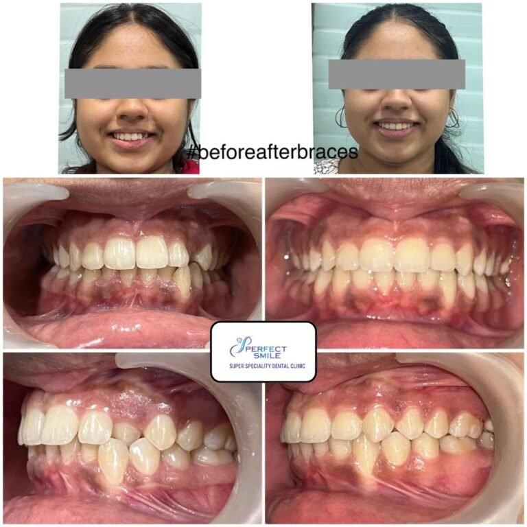 Smile makeover before and after braces treatment in Kolkata – Perfect Smile Super Speciality Dental Clinic.