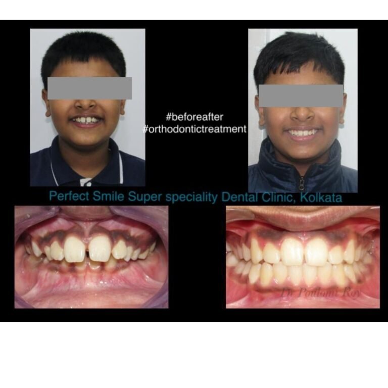 Before and after braces treatment in Kolkata – Perfect Smile Super Speciality Dental Clinic showing teeth alignment results.