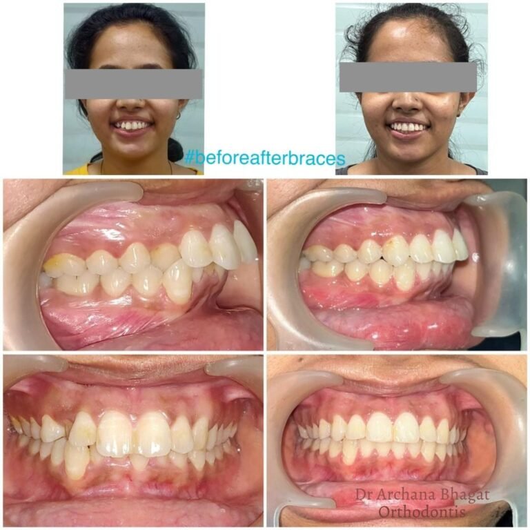 Patient braces transformation result – braces treatment near me Kolkata for straight teeth.