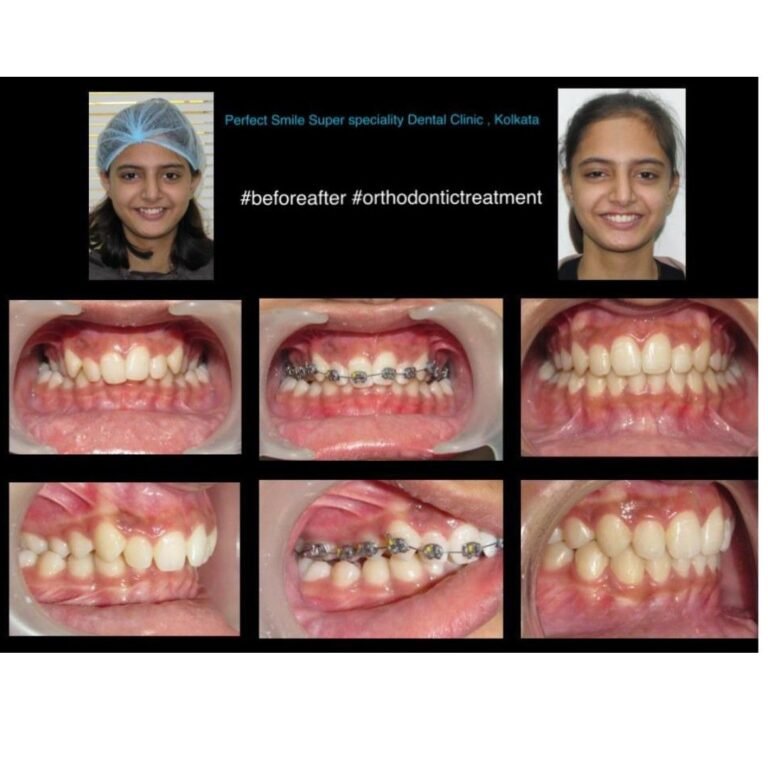 Perfect Smile Super Speciality Dental Clinic Kolkata – braces before and after photo of patient with ceramic braces.