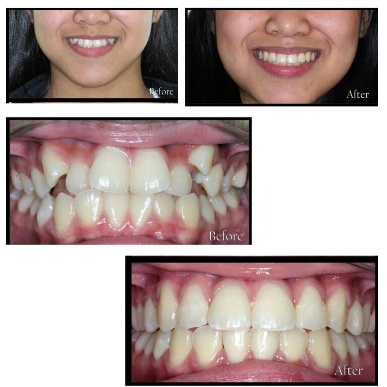 Braces treatment near me – smile transformation after 22-month orthodontic treatment in Kolkata.