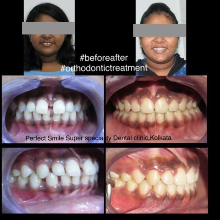 Braces treatment in Burdwan – before and after orthodontic result by expert orthodontist.