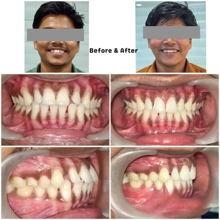 Before and after braces treatment in Kolkata– metal braces smile correction by dental specialist.