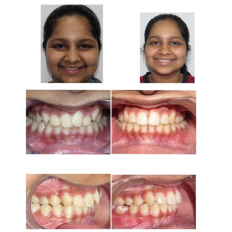 Braces treatment in Kolkata – orthodontic alignment result with visible teeth improvement.